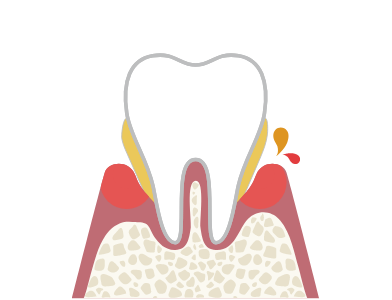 歯肉炎（中期）