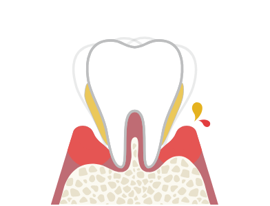 歯槽膿漏（末期）